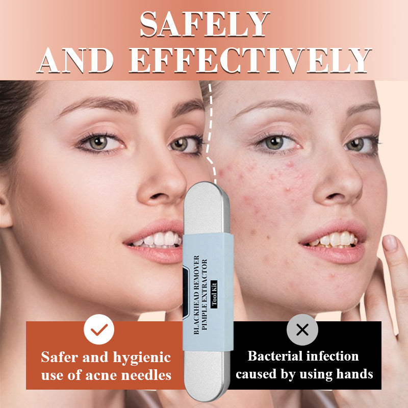 💓2025 HOT SALE 50% OFF💥Medical Grade Blackhead Extraction Tool Kit